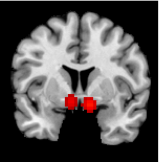 spm5_nacc_coronal.png